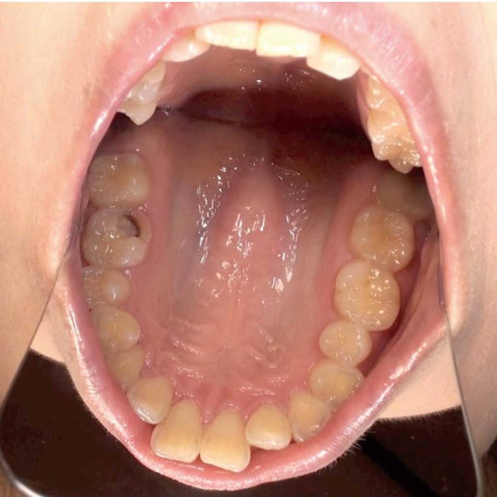 【歯垢採取〜歯みがき〜糸ようじ〜鏡で観察】口腔羞恥！素人歯科淫診　小春ちゃん