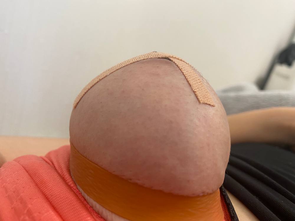 乳管責め