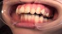 【Dental fetish interview-oral size measurement-observation-mouth aperture】Oral shame! Amateur dental examination Koharu-chan