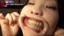 口腔ドキュメント　歯列矯正中の女〜開口器＆大型ミラーで観察