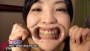 口腔ドキュメント　歯列矯正中の女〜開口器＆大型ミラーで観察