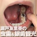 開口器をつけて口腔内丸出しの瀬戸友里亜の虫歯＆銀歯観光しました