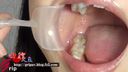 開口器を装着した吉村杏菜ちゃんの口腔内、銀歯や喉ちんこを接写観察
