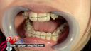 【口腔フェチ】歯列矯正中の素人リョウコの歯・口腔内を超接写観察