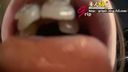 A waterproof camera sneaks into Ryoko's oral cavity during orthodontics and licks a real lens