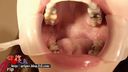 Silver tooth treatment scar Aya Kisaki with a long tongue Ippai oral & banana