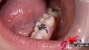 63毫米長舌頭柯高利安戴著嘴巴張開，欣賞兩顆銀牙口腔和刷牙