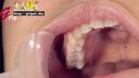 【歯フェチ】女子大生かなみちゃんの銀歯５本口腔を開口器装着鑑賞