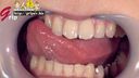 【歯フェチ】女子大生かなみちゃんの銀歯５本口腔を開口器装着鑑賞