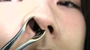 FJF-1874 Sneezing With Nasal Observation → Finger Nose Hook →