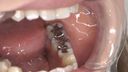 Ayako's teeth. Leave for 1 year after inlay detachment! To a worthy crown daughter　