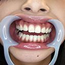 フルハイビジョン│【歯フェチ】ゆあちゃんの美しい歯並びとキラっと光る銀歯を観察！