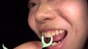 치과 치료 흔적이 많은 어린이의 치아는 무엇입니까? 미사키(6) FETK00520