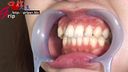 虫歯＆銀歯セブン妻の綾の銀歯大量発見！虫歯治療中口腔を開口器鑑賞