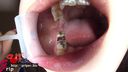 蛀牙與銀牙七妻阿雅的銀牙大規模發現！ 齲齒治療期間口腔的張口欣賞器