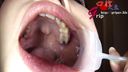 Tooth decay & silver tooth Seven wife Aya's silver tooth mass discovery! Mouth opening appreciator of oral cavity during caries treatment