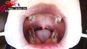 Tooth decay & silver tooth Seven wife Aya's silver tooth mass discovery! Mouth opening appreciator of oral cavity during caries treatment