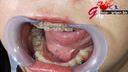 矯正中熟女の美保の歯列矯正スタート1年半の口腔内を開口器鑑賞