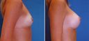 Comparison of before and after breast augmentation surgery (results of verifying the effect of silicone bags)