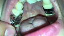 Rattling teeth at a level where the total cost of treatment is worrisome Aya(1) KITR00222