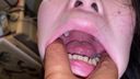 口腔モンスター現る！二段前歯と詰め物だらけの奥歯 アオバ KITR00313