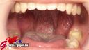 60mm long-tongue Mai Miori's oral cavity immediately after wisdom tooth extraction with mouth aperture