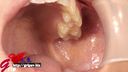 60mm long-tongue Mai Miori's oral cavity immediately after wisdom tooth extraction with mouth aperture