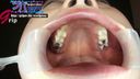 業餘OL Haruka在齲齒治療期間的4顆銀牙在口腔內開口特寫和刷牙
