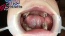 素人OL春香の銀歯4本の虫歯治療中口腔内を開口器接写＆歯みがき