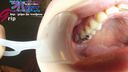 아마추어 OL 하루카의 은색 치아 4 개 입 안의 충치 치료 중 클로즈업 & 칫솔질