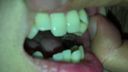 Rattling teeth at a level where the total cost of treatment is worrisome Aya(1) KITR00222