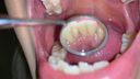 [Personal shooting] Black gal AV actress RISA's well-brushed teeth found cavities! ??　RISA③【Y-040】