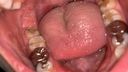 [個人拍攝] ※覆蓋的銀牙和蛀牙 ※當我用牙科鏡檢查派遣店員的嘴時，銀色世界w南[Y-100]中有真菌