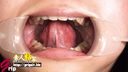 素人女子大生まどかさんの内向き奥歯が特徴の口腔内を開口器で鑑賞