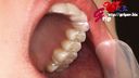 長舌美形RQ早川瑞希の差し歯1本綺麗な歯並びの口腔内を開口器鑑賞
