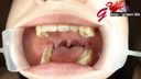 순수 아마추어 단대생 사츠키의 아름다운 이빨과 목 안쪽 아소코를 입 조리개로 입 클로즈업으로 감상