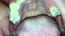 White folds on the upper jaw, yellowed teeth, well-formed nose hair Karen(3) KITR00235