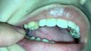 Orthodontic Teeth Mania Feeling Tears! Longing for tearful beautiful dentition Yui(1) KITR00264