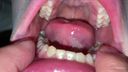 치료 자국이 극히 적지만 못생긴 치아 색깔을 가진 아름다운 치열 Yu(2) KITR00278
