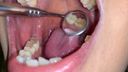 【個人撮影】黒ギャルAV女優RISAの良く磨かれた歯に虫歯発見！？　RISA③【Y-040】