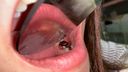 [個人拍攝] ※覆蓋的銀牙和蛀牙 ※當我用牙科鏡檢查派遣店員的嘴時，銀色世界w南[Y-100]中有真菌