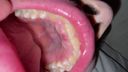 치료 자국이 극히 적지만 못생긴 치아 색깔을 가진 아름다운 치열 Yu(2) KITR00278