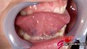 女子大生の繭の前歯矯正中＆治療済み歯がある口腔内を開口器接写