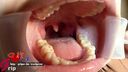 女子大生の繭の前歯矯正中＆治療済み歯がある口腔内を開口器接写