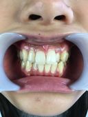 Tooth observation Kotomi Shinomisaki's tooth brushing and hypersensitivity!