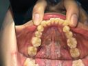 Tooth observation Kotomi Shinomisaki's tooth brushing and hypersensitivity!