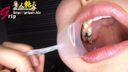 Close-up view of amateur OL Akina's four silver teeth and an oral cavity with orthodontics while left unattended