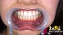 아마추어 OL 아키나의 은색 치아 4개와 치열 교정이 있는 구강을 방치한 채 클로즈업 모습