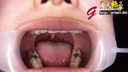 아마추어 OL 아키나의 은색 치아 4개와 치열 교정이 있는 구강을 방치한 채 클로즈업 모습