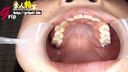 清純女子大生の紗月ちゃん最近虫歯が出来た口腔内を開口器接写鑑賞